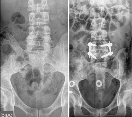 E.ANQUILOSANTE RX Artrodesis lumbar