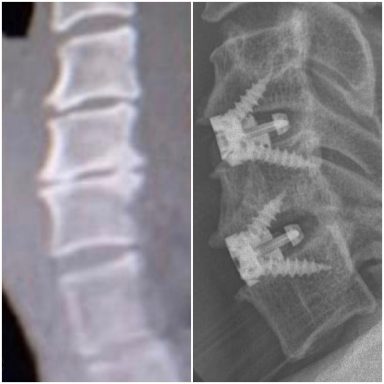RX Artrodesis cervical